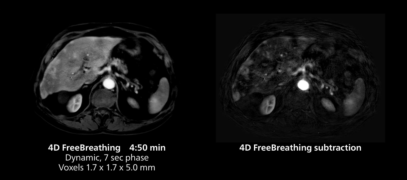 Knee mri three