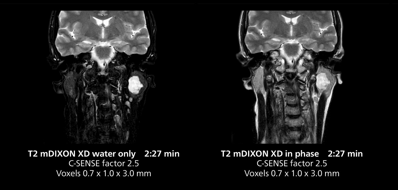 Salivary gland mri two