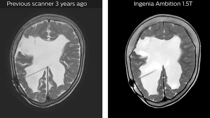 Hydrocephalus post hemorrhagic