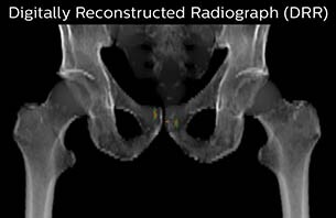 Turku MR-RT Digitally Reconstructed Radiograph case 6