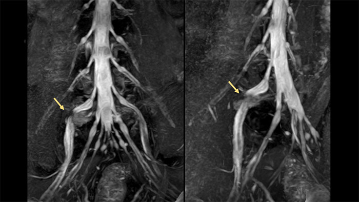 MRI nerve visualization informs surgery