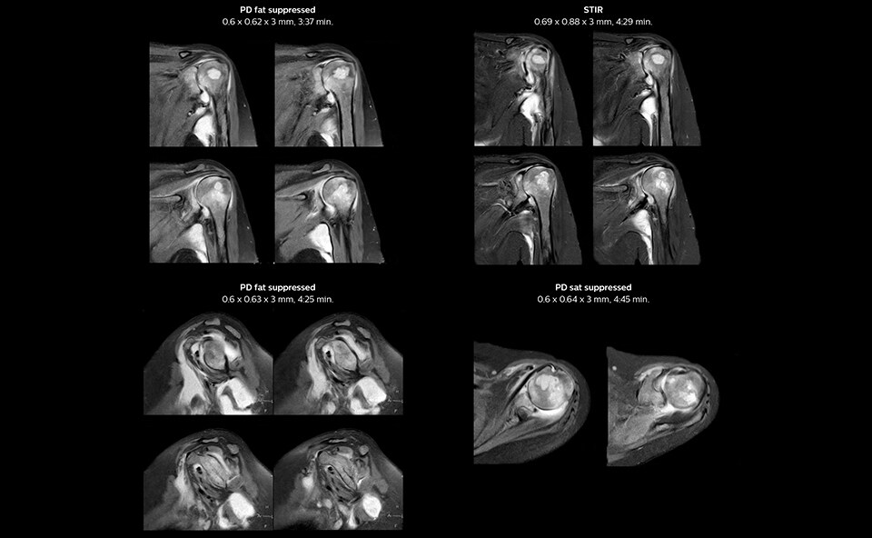 MRI of the shoulder on Ingenia Prodiva 1.5T