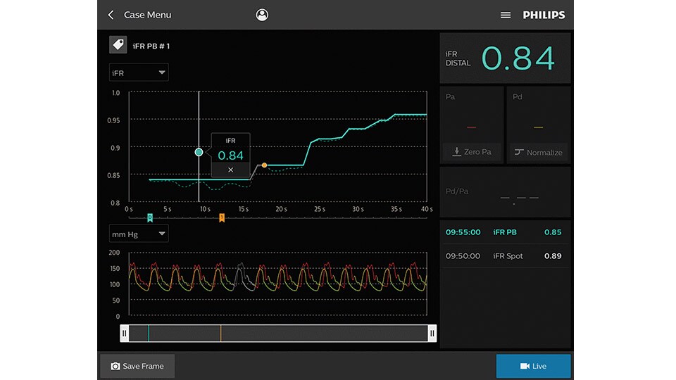 iFR visuals