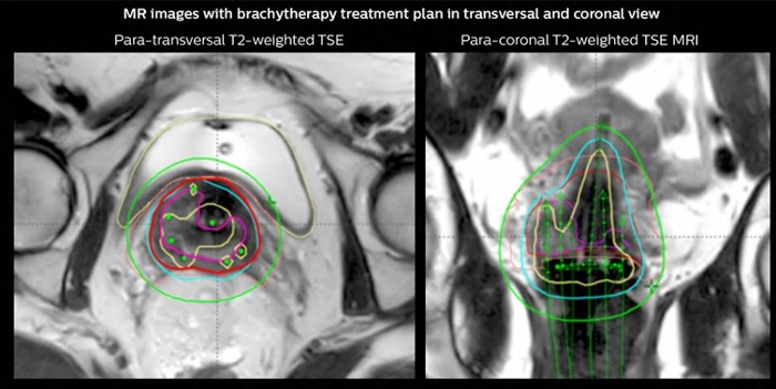 3D MRI-guided brachytherapy