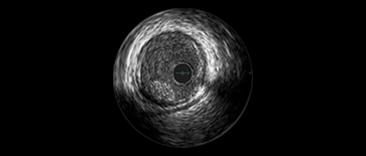 Saphenous vein graft and thrombus lesions masthead